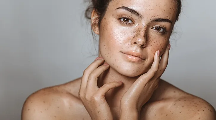 Melasma Treatment in Johar Town Lahore | The Skin Care Studio