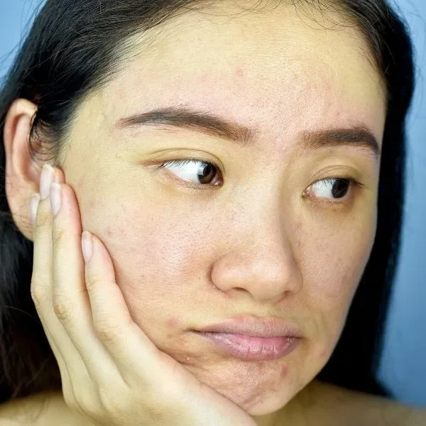 Dull & Dehydrated Skin Treatment in Johar Town Lahore