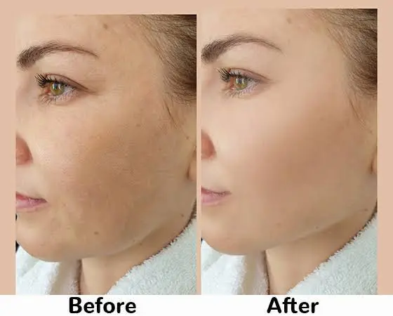 11-Step 3D HydraFacial