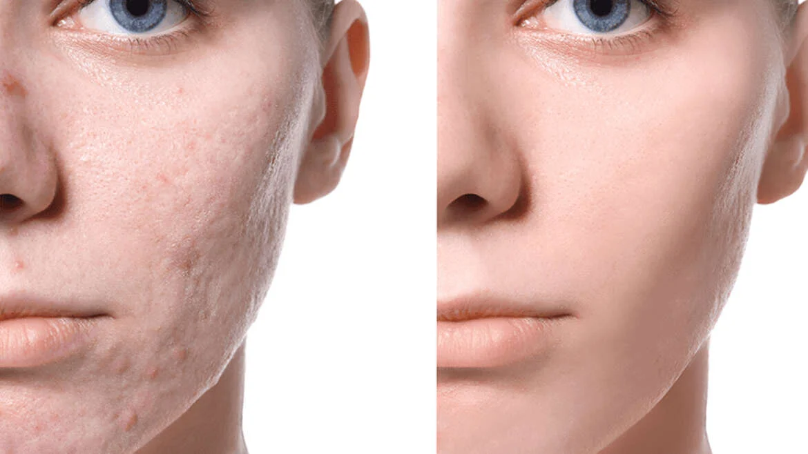 Acne Scar Treatment