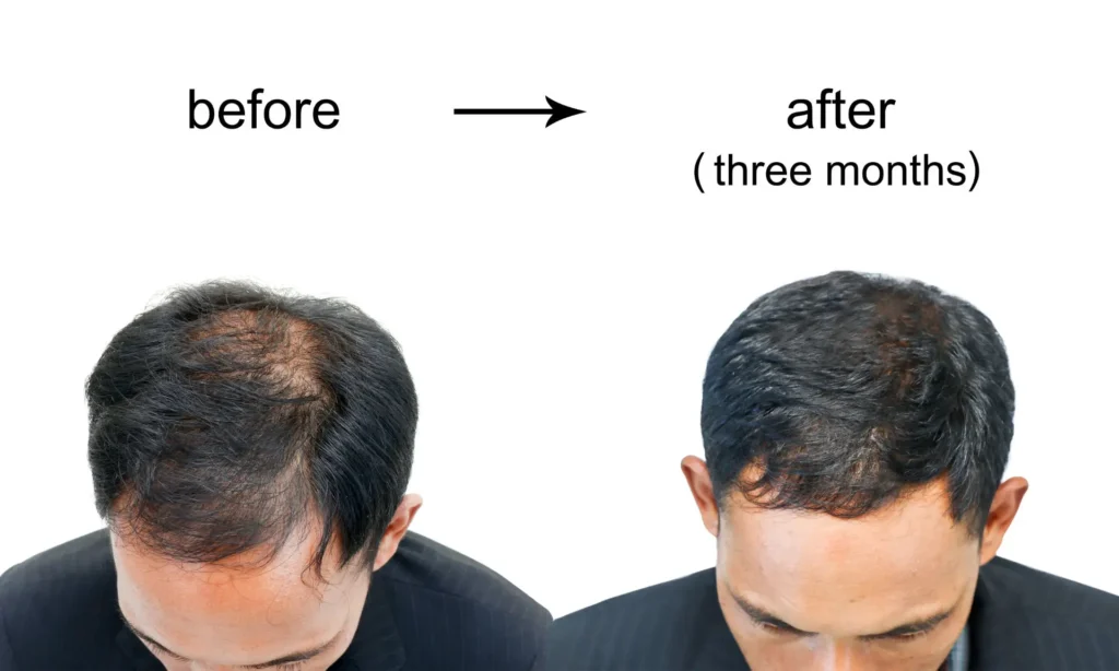 Hair Loss Treatment