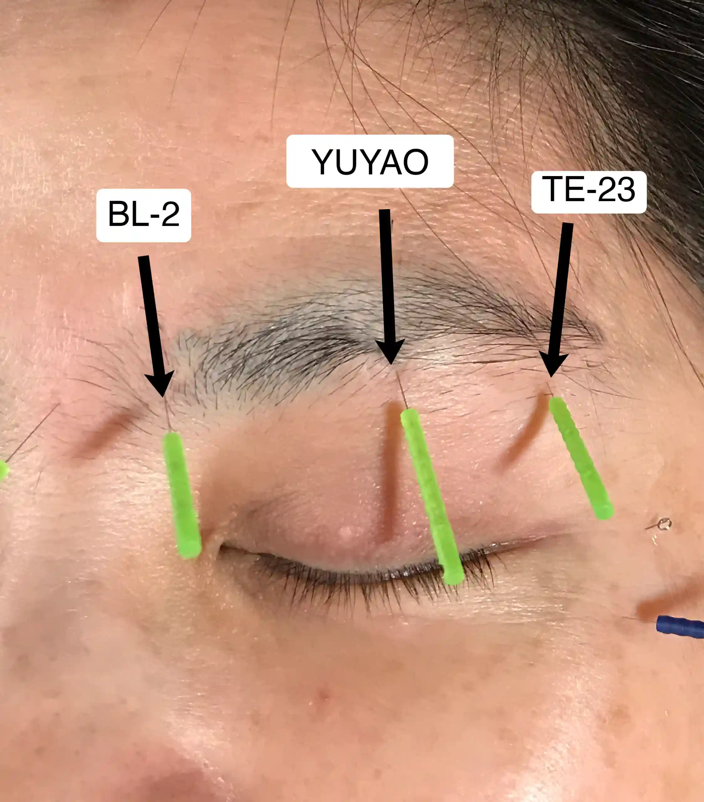 Sagging Eyelids Treatment in Lahore