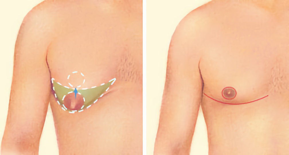 Man Chest Treatment