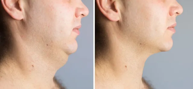 HIFU Face Lift