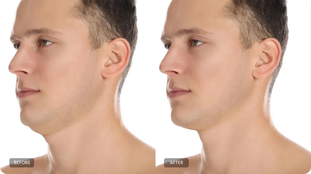 Neck Lift for Men