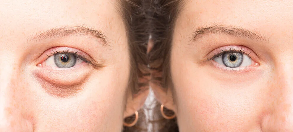Sagging Eyelids Treatment in Lahore