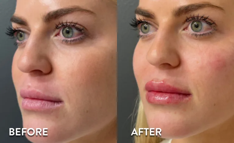 Cheek Fillers