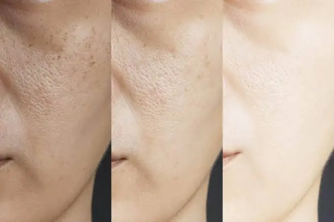 Open Pores Treatment
