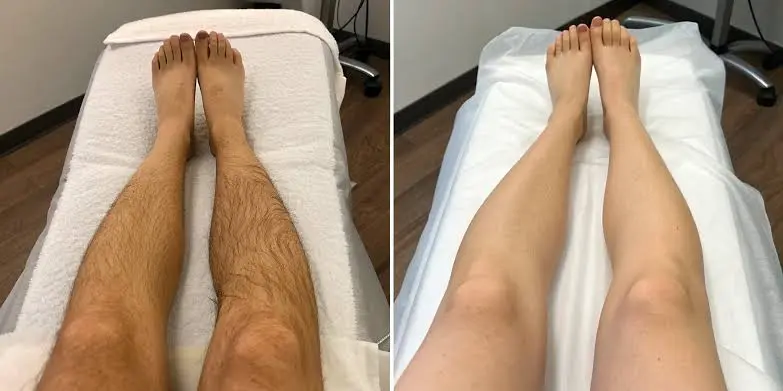 Legs Hair Removal