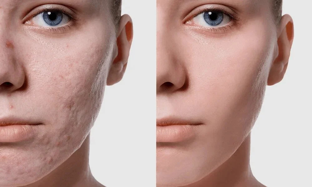 Pico Laser Treatment