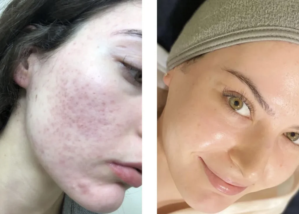 Microneedling