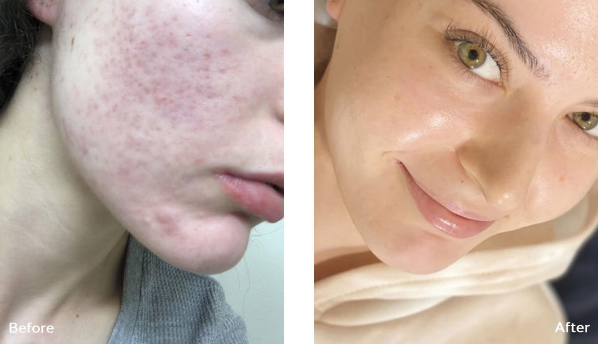 Skin Whitening Treatment