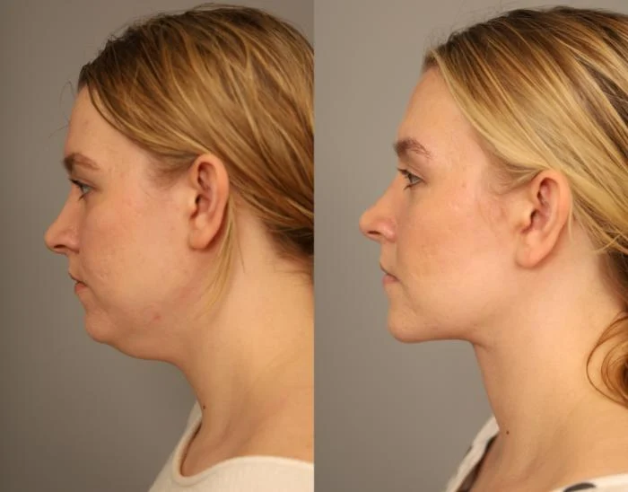 Neck Lift for Women