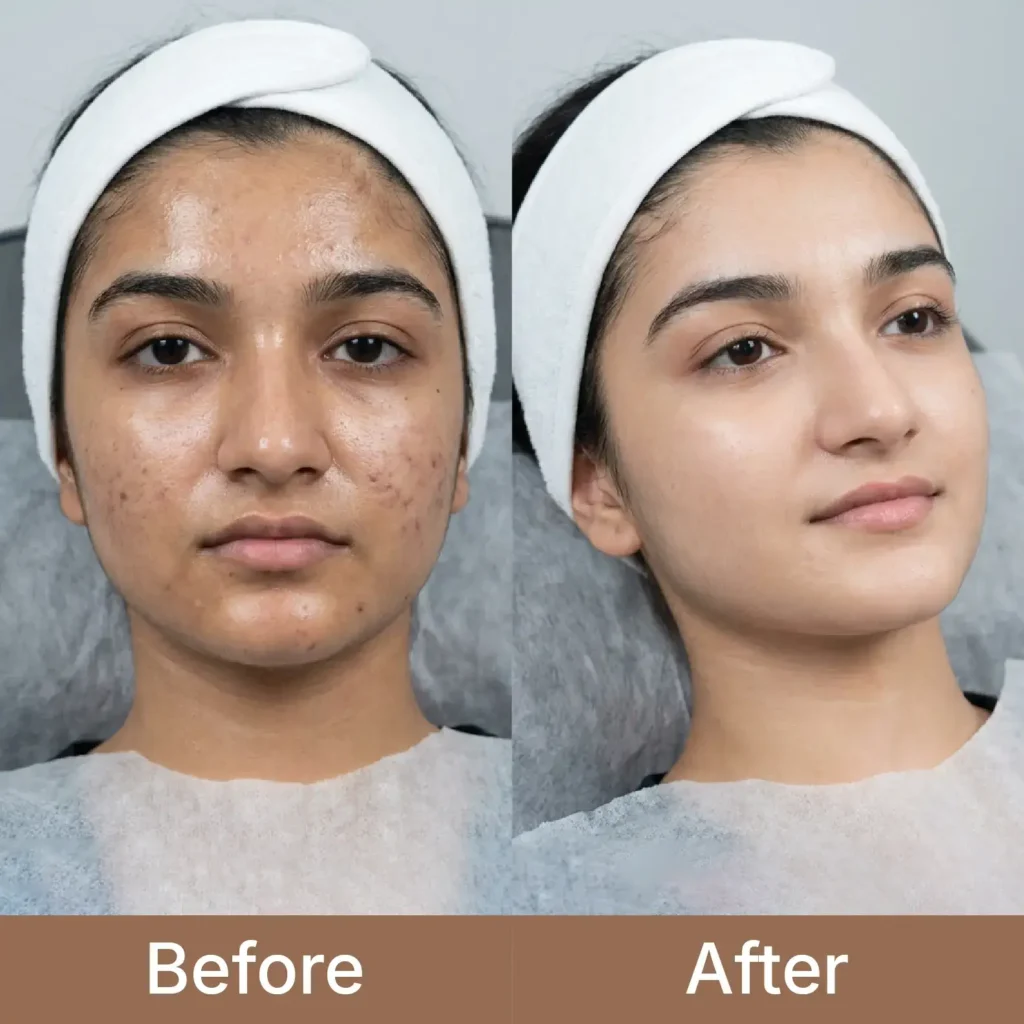 Facials Treatments