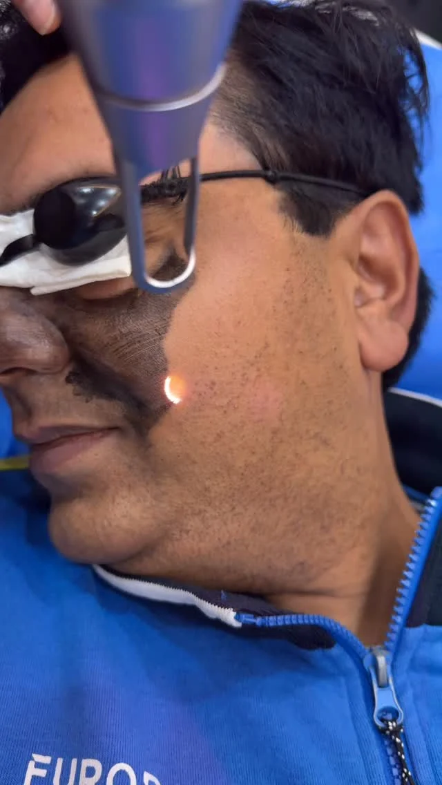 Carbon Laser Treatment -

The Skin

Care Studio

Experience clearer, brighter and smoother skin with our advanced Carbon Laser.

Benefits:

Deep pore cleansing

Controls oil & acne

Tightens open pores

Bright, glowing complexion

Reduces pigmentation & dark spots

Instant skin rejuvenation

Location: Near Johar Town, PIA Road, PIA Society, 40-C

Block

0302 0010 492

The Skin Care Studio

#CarbonLaser #CarbonFacial #SkinRejuvenation #Glowing Skin

#Laser Treatment #TheSkinCareStudio #Lahore Clinic #Aesthetic Clinic #SkinCareLahore #BeautyClinic #LaserFacial

#SkinGlow #Pores Treatment #AcneControl