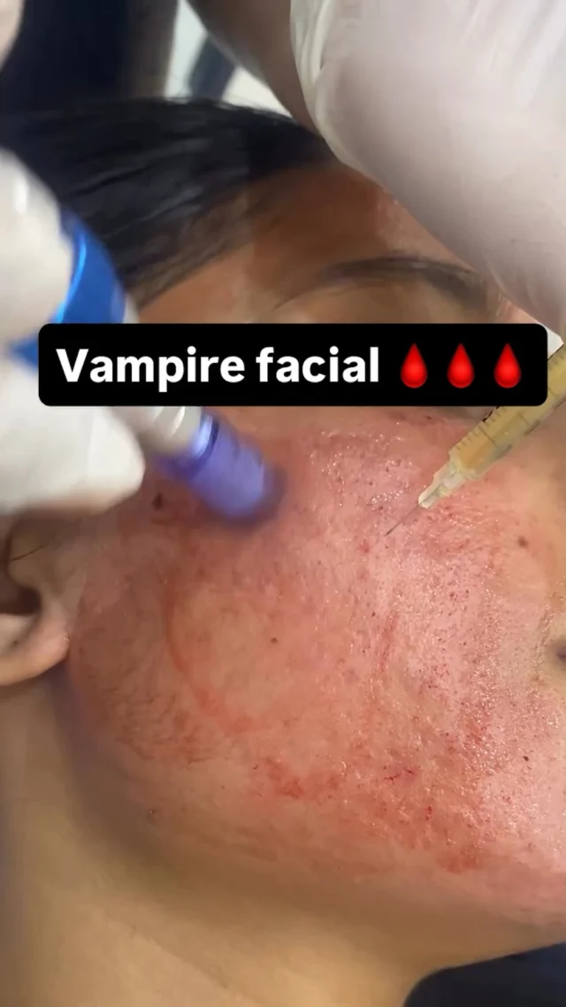 Revive your skin from within. The Vampire Facial (PRP) boosts collagen, improves texture, and restores your natural glow using your body’s own healing power.