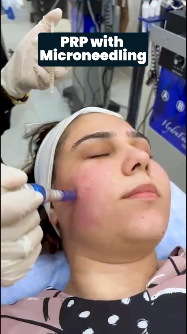 PRP with Microneedling works by creating micro-channels in the skin and delivering platelet-rich plasma deep inside to promote healing, boost collagen, and restore healthy, glowing skin.

Book your appointment today!
📞 0302 0010492
Visit Us
📍 Near Johar Town, PIA Road, PIA Society, 40C Block, Lahore
.
#LaserHairRemoval #SmoothSkinJourney #LaserTreatment #SkinStudioPK #LahoreSkinCare #AestheticClinic #ConfidenceInYourSkin #GlowWithCare #SmoothSkinGoals #SkinCareThatWorks #FeelFlawless #LahoreAesthetics #LahoreBeauty #PermanentHairReduction #ByeByeWaxing #NoMoreShaving #SilkySmoothSkin #LaserExperts #HydraFacialLahore #PRPLahore #AestheticExperts #SkincareLahore #BeautyClinicLahore #SkinGlow