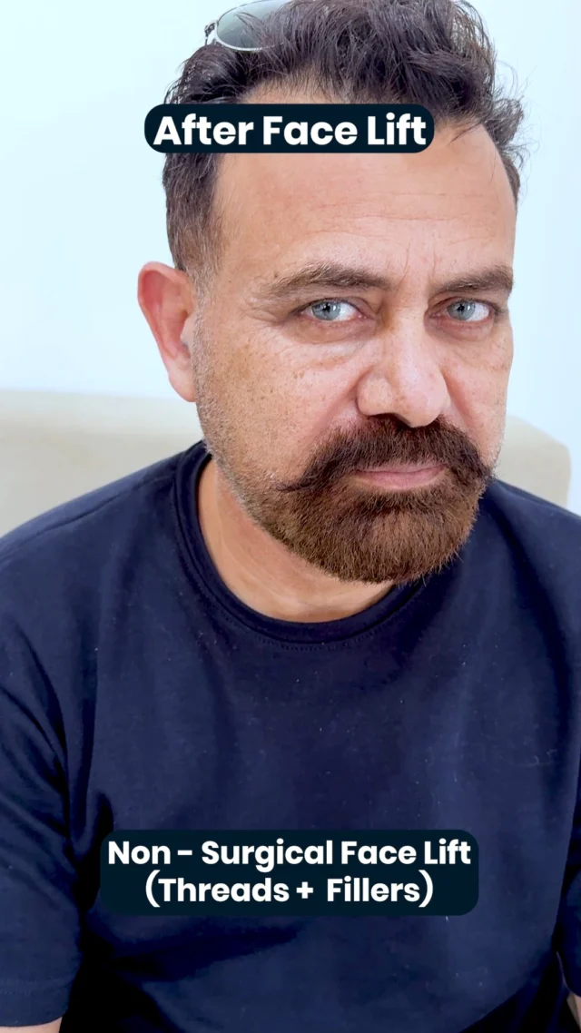 A lift without surgery. ✨ Our client just experienced a non-surgical face lift with threads & fillers designed to restore volume, lift the skin, and bring back a youthful glow.

Book your appointment today!
📞 0302 0010492
Visit Us
📍 Near Johar Town, PIA Road, PIA Society, 40C Block, Lahore
.
#LaserHairRemoval #SmoothSkinJourney #LaserTreatment #SkinStudioPK #LahoreSkinCare #AestheticClinic #ConfidenceInYourSkin #GlowWithCare #SmoothSkinGoals #SkinCareThatWorks #FeelFlawless #LahoreAesthetics #LahoreBeauty #PermanentHairReduction #ByeByeWaxing #NoMoreShaving #SilkySmoothSkin #LaserExperts #HydraFacialLahore #PRPLahore #AestheticExperts #SkincareLahore #BeautyClinicLahore #SkinGlow